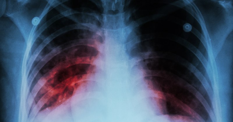 Pulmonary Tuberculosis ( TB )  :  Chest x-ray show alveolar infi